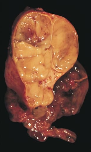 Thymoma - Wikipedia