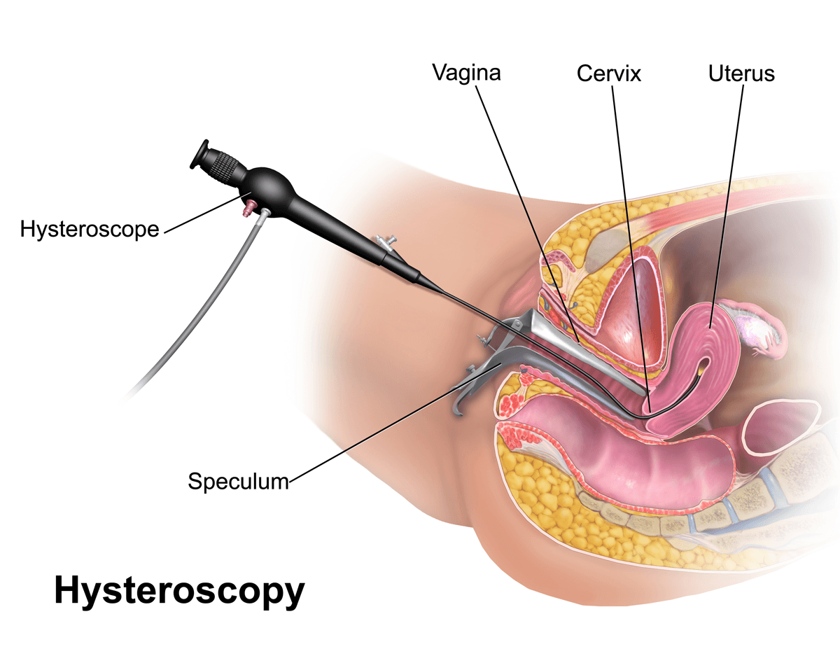 Hysteroscopy - Wikipedia