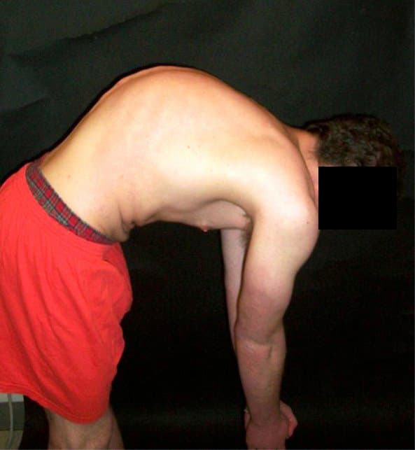 Maladie de Scheuermann — Wikipédia