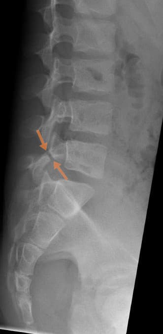 Spondylolysis - Wikipedia