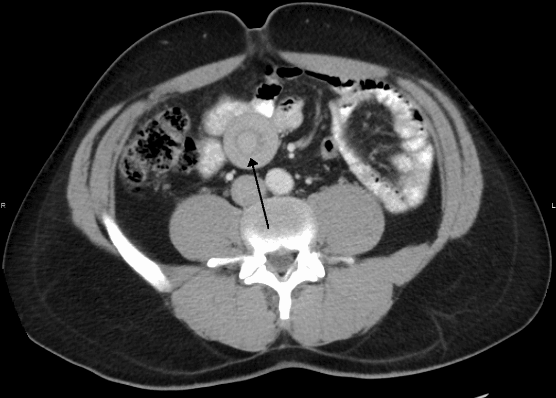 Intussusception (medical disorder) - Wikipedia