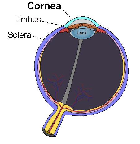 Recurrent corneal erosion - Wikipedia