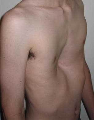 Pectus excavatum — Wikipédia