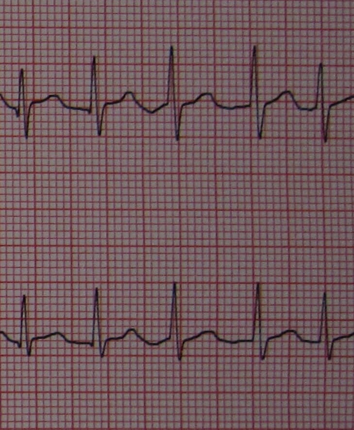 Fibrillation atriale — Wikipédia