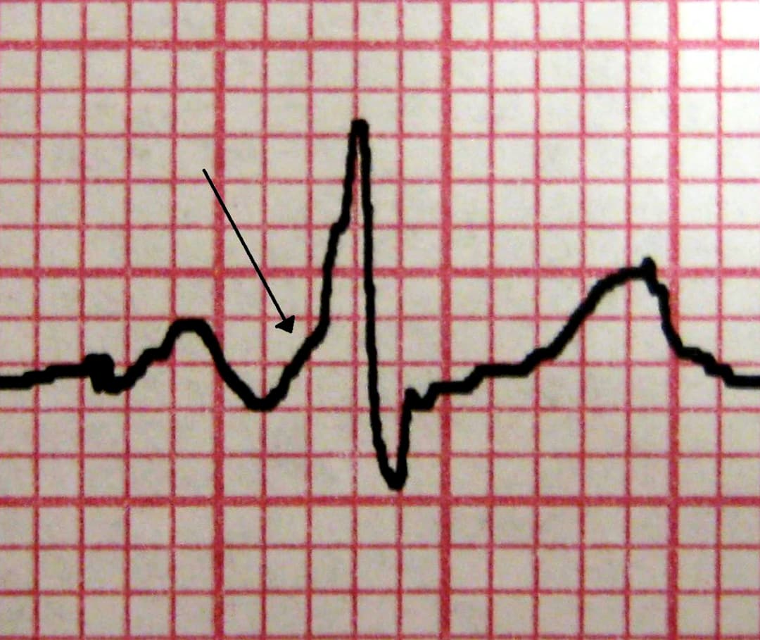 Syndrome de Wolff-Parkinson-White — Wikipédia