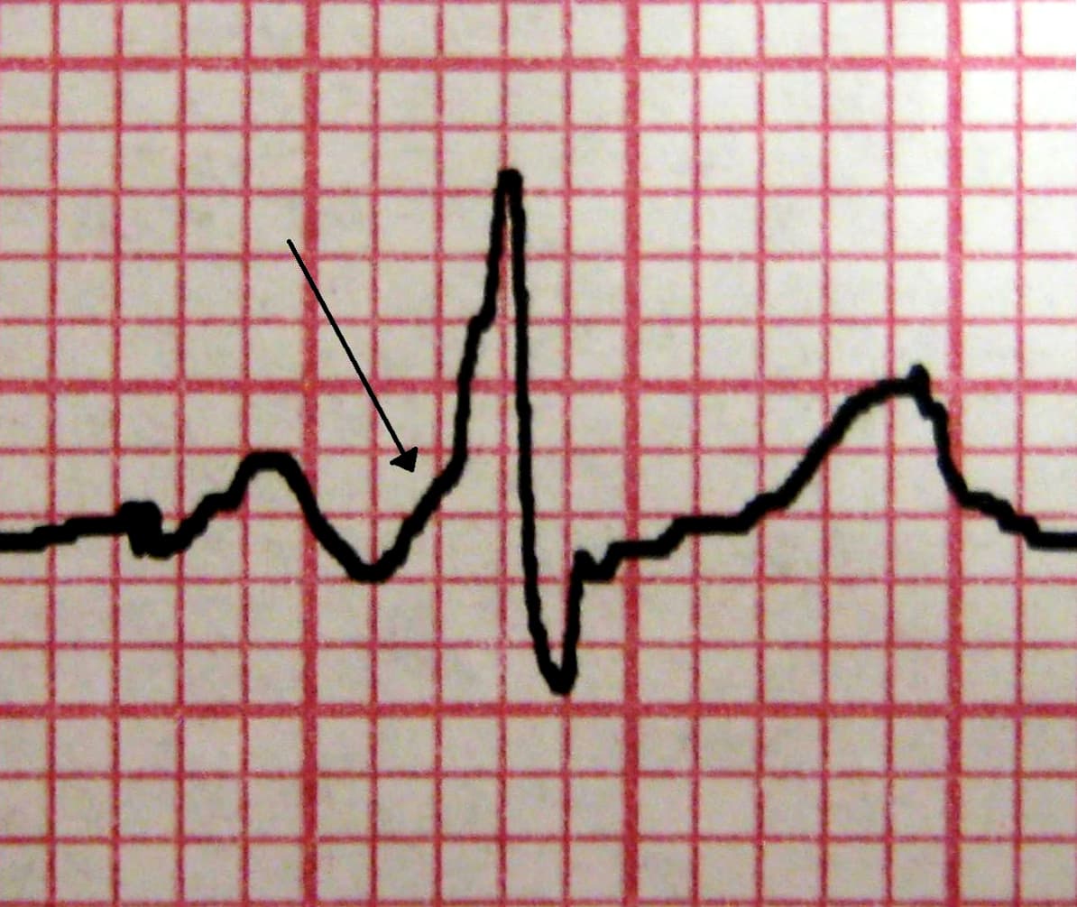 Syndrome de Wolff-Parkinson-White — Wikipédia
