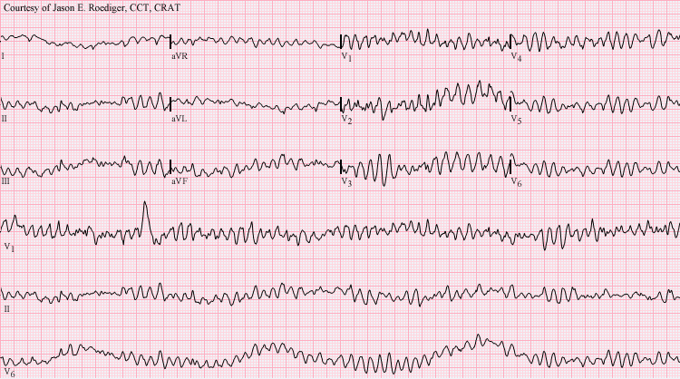 Arrhythmia - Wikipedia