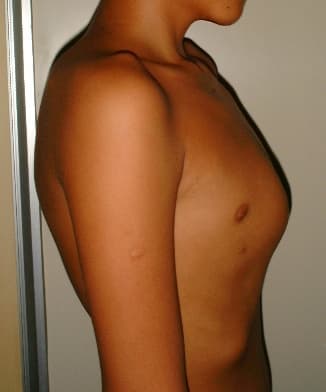 Pectus carinatum — Wikipédia