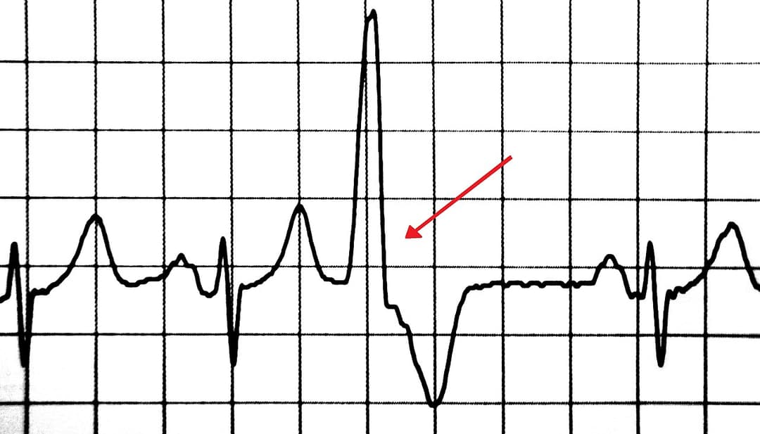 Premature heart beat - Wikipedia